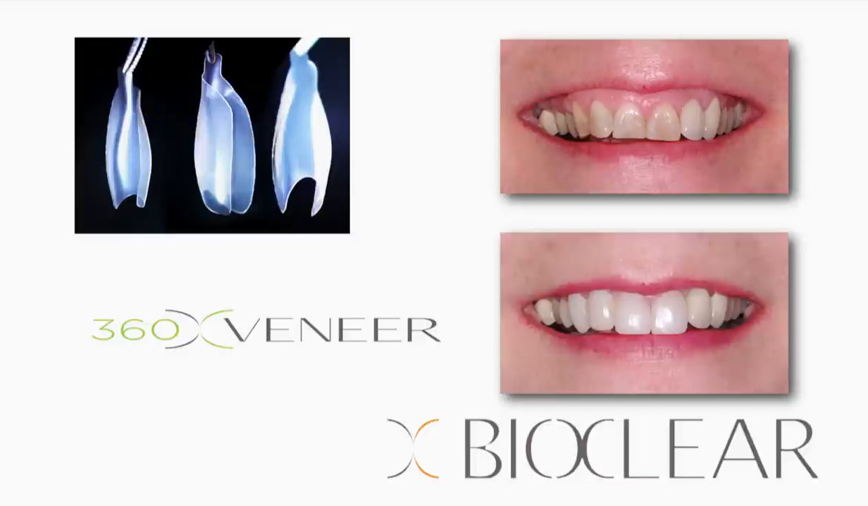 No.10 360° Veneer Matrix Series-12ct