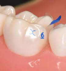 No.12 Bioclear Evolve Posterior Matrix 리필