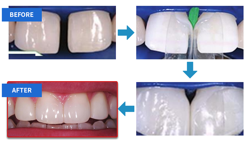 Bioclear 치간 수복 매트릭스 제품 이미지